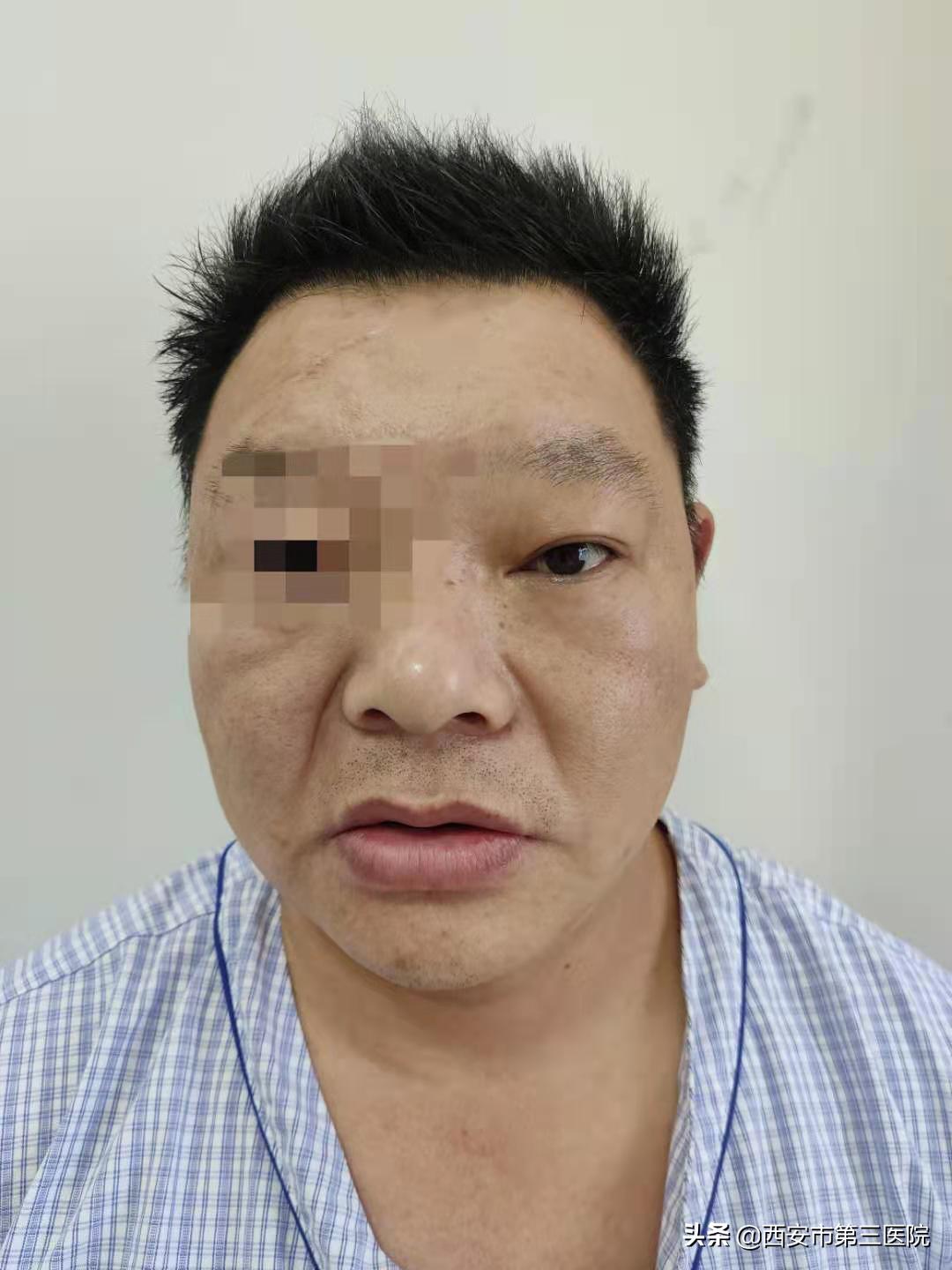 治愈鼻窦炎有好的方法么,鼻窦炎反复发作疼痛难以忍受