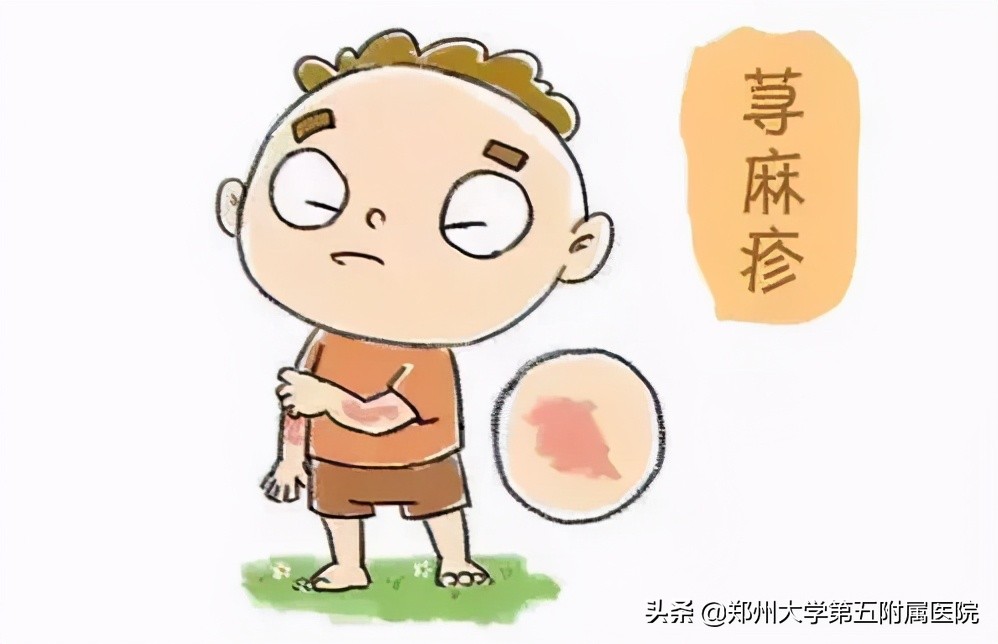 风疙瘩解决办法,风疙瘩的症状和图片