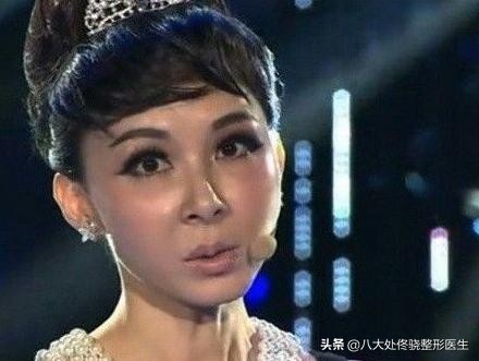 注射肉毒素脸部变化,肉毒素可以改变大小脸吗