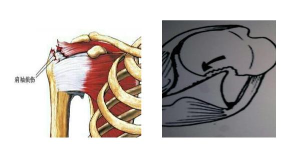 习惯性肩关节脱臼如何改善,肩关节脱位容易形成习惯性脱位吗