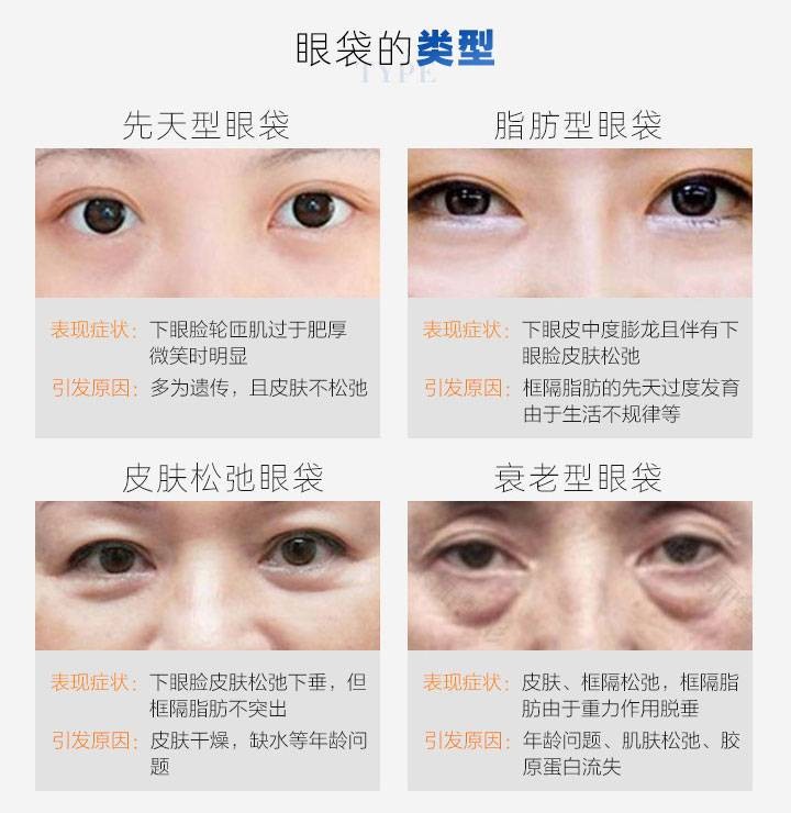 去眼袋的技巧，简单几招，轻松解决烦人的黑眼圈，快来学习吧
