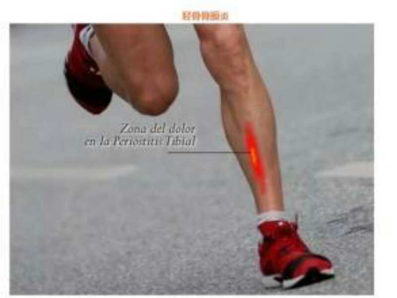 跑步膝关节韧带损伤,跑步胫骨骨膜炎