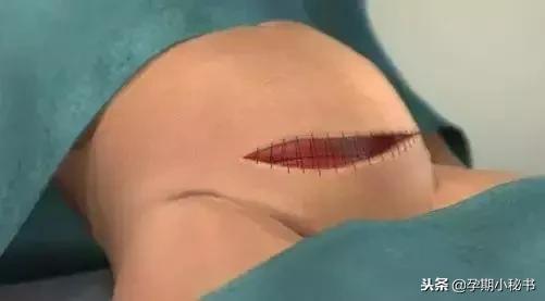 顺产生孩子剖腹产的真实流程,顺产剖腹产生孩子的真实流程