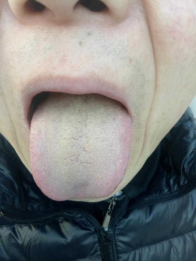 肾虚寒湿证的治法,肾虚湿热症用什么中药调理