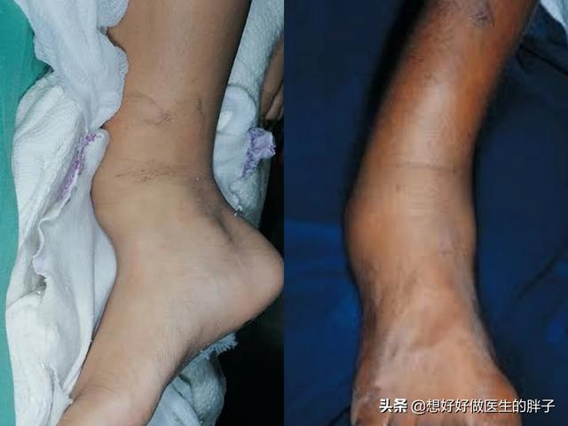 关于踝关节扭伤的正确处理方法,崴脚得重视