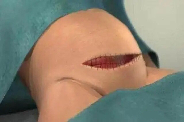 剖宫产真的比顺产好吗,剖宫产全过程解析