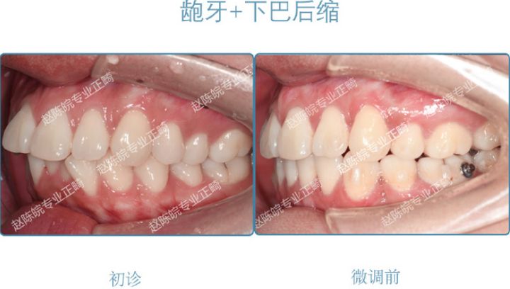 杭州成人隐形矫正牙齿优惠,矫正牙齿杭州无创伤