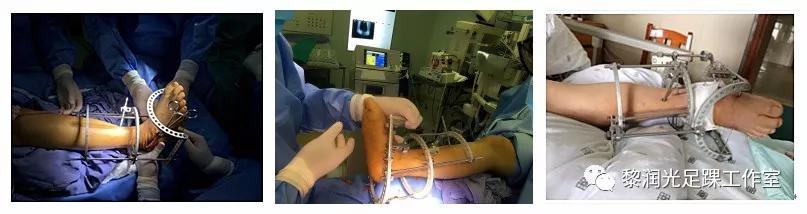 伊里扎洛夫外固定架治疗足部畸形,足部畸形矫正的技巧