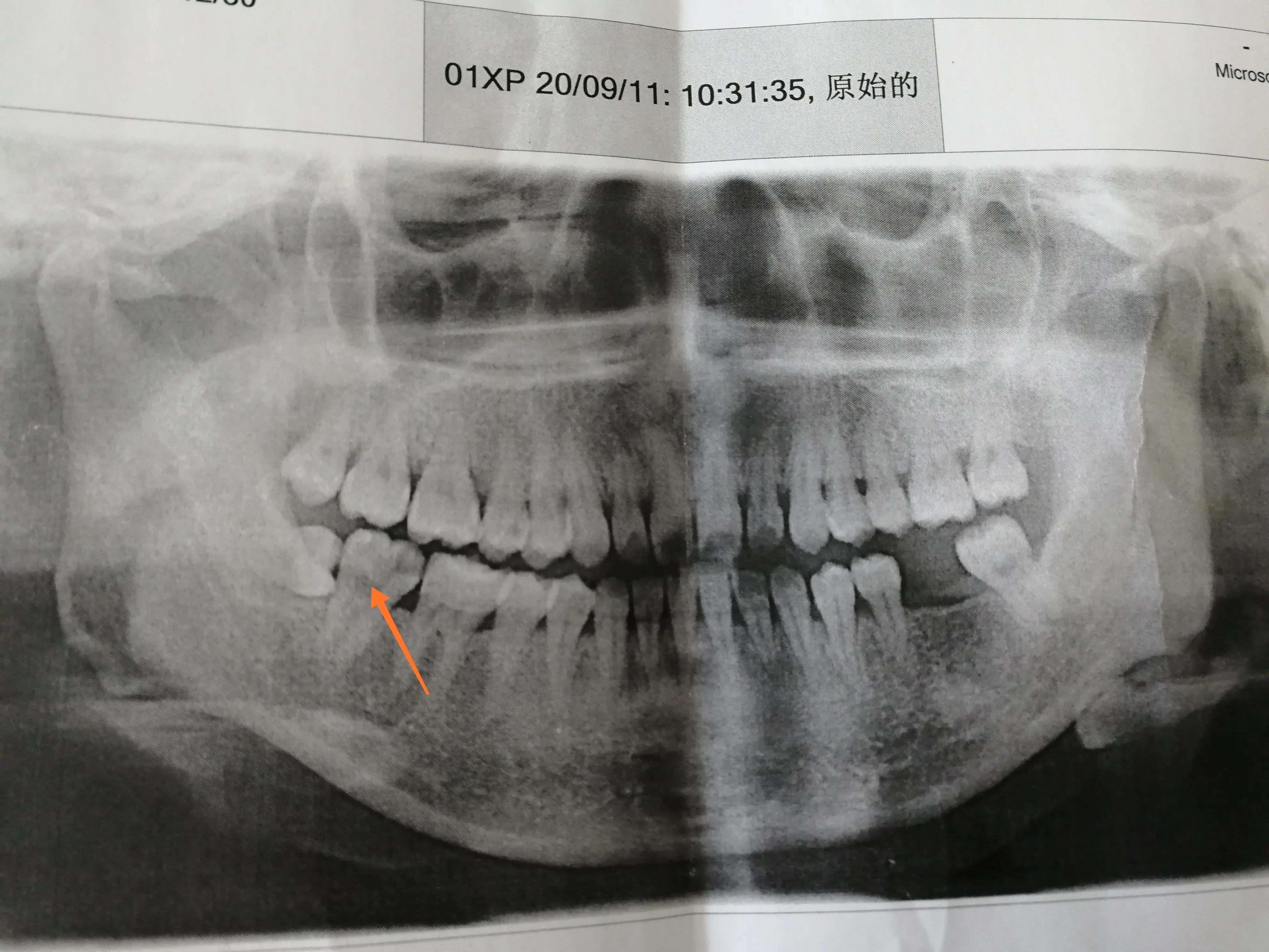 上海同济大学附属口腔医院怎么样,上海同济口腔根管治疗价格