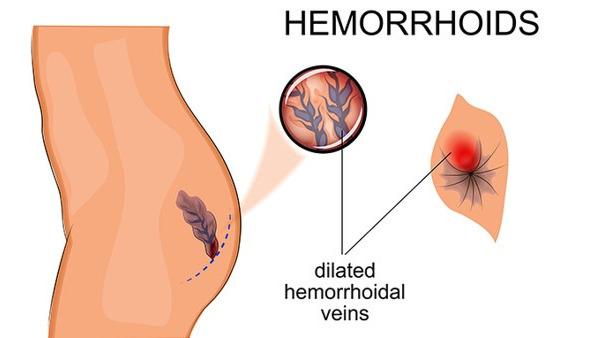 产后痔疮很严重怎么办,产后痔疮快速止痛小妙招