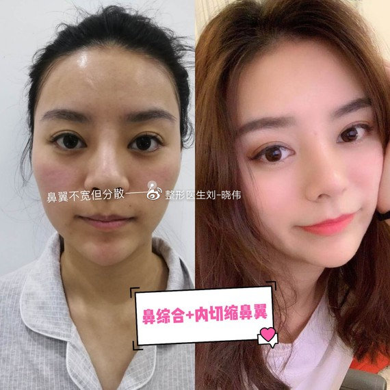 鼻翼肥大适合打鼻翼钉吗,鼻翼大怎么缩小且不留痕迹