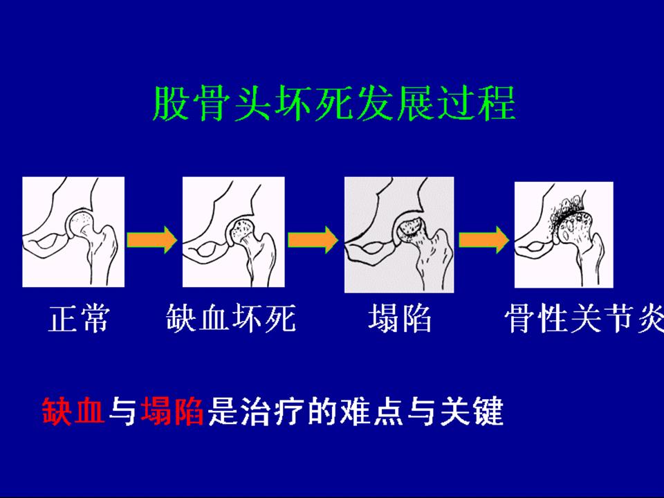 髋关节疼痛自愈的最佳方法,髋关节疼痛走路一瘸一拐