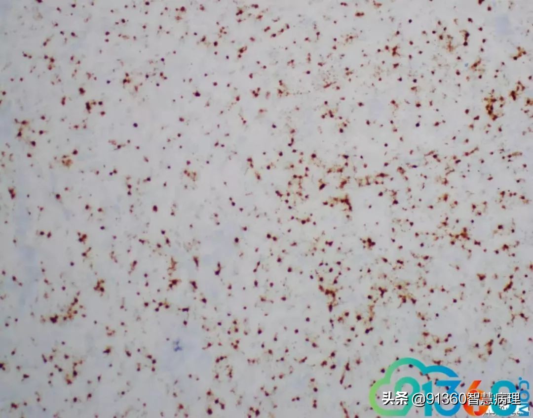 宫颈腺癌silvaa型用化疗吗,宫颈腺癌silvab型需要放疗几次