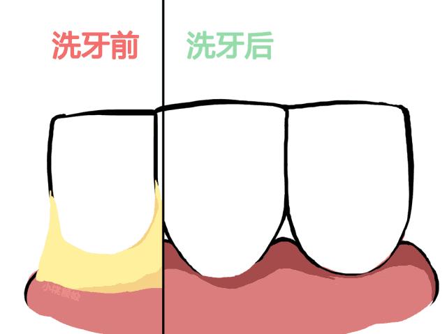 用手抠牙结石有什么不良影响,用手抠下一块牙结石