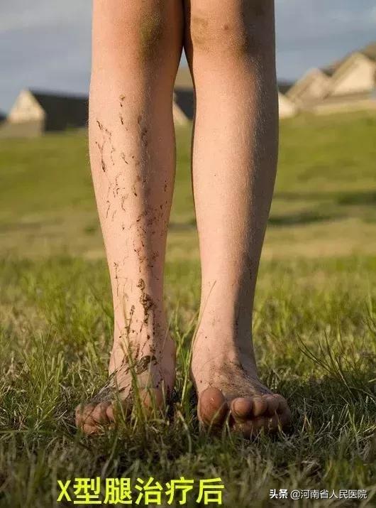 宝宝脚尖站立的原因,宝宝脚尖对脚尖走路怎么回事