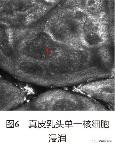 皮肤共聚焦显微镜能查什么,皮肤镜和共聚焦显微镜