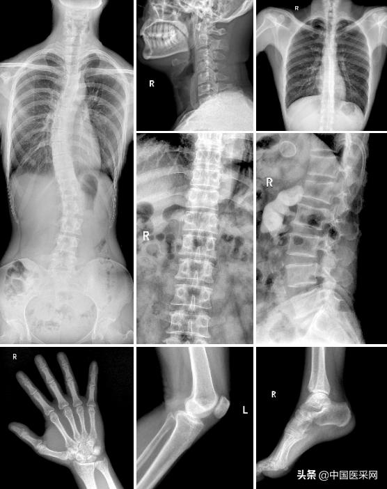 安健科技引领普放创新，发布业界首款超高端悬吊动态DR
