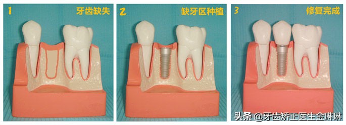 牙齿矫正每次加力都很痛,牙齿矫正每次加力都疼