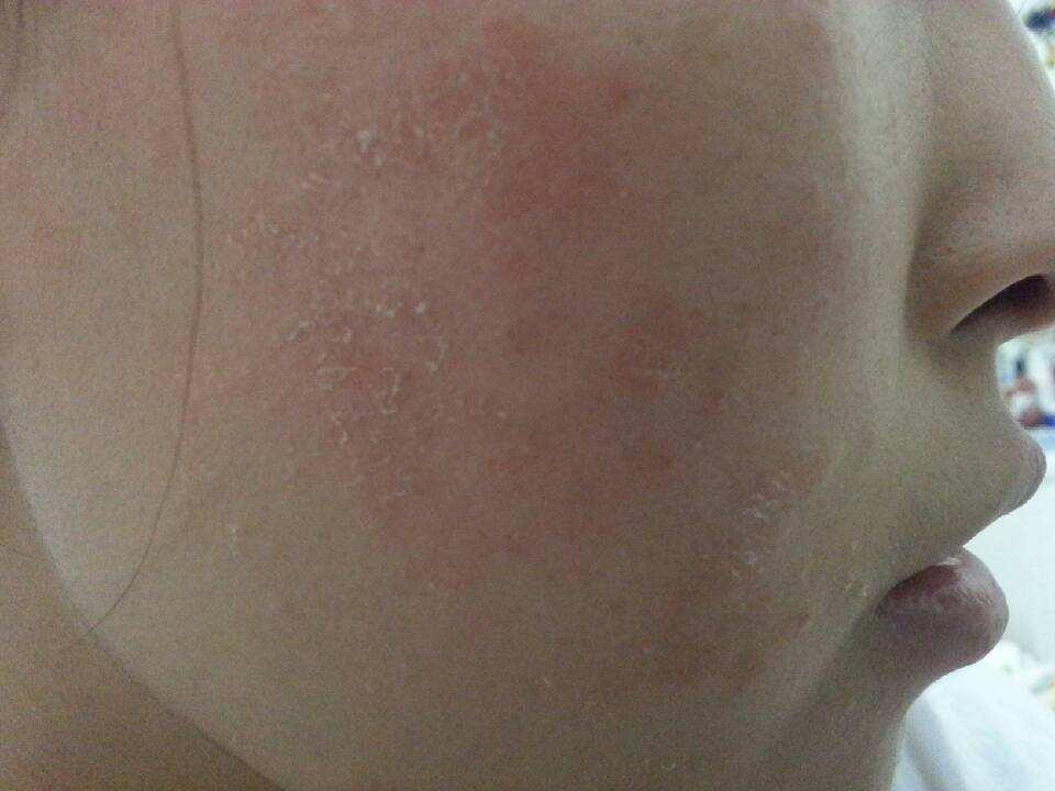 100人里就有20人中招，清洁不到位导致脸上冒虫，毛孔需要早清洁