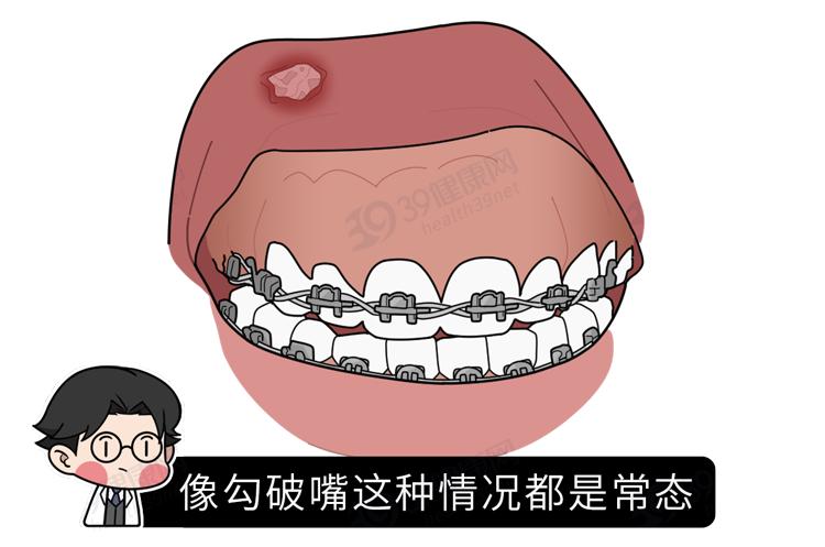 隐形牙套能矫正整齐吗,为什么戴牙套会让人变好看