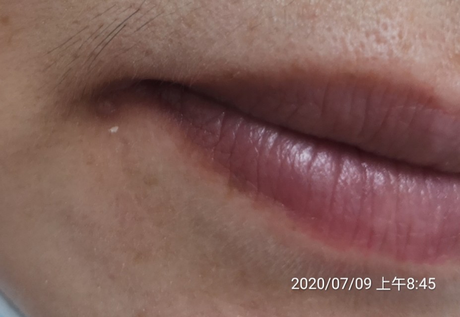 治疗耳石症的五种中成药,有没有治疗耳石症的西药