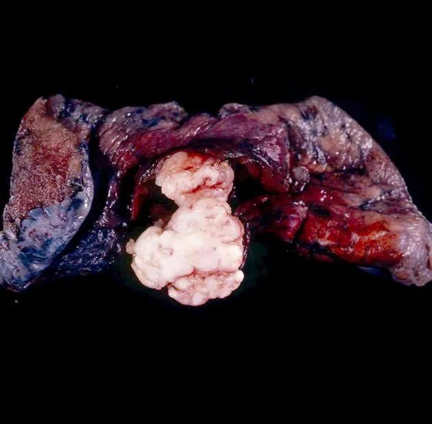肺内见多发小囊状无纹理透光影,肺内肿块并厚壁空洞