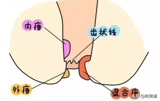 女子近一周大便出血,肛门疼痛且有灼热感,因1种常见的肛肠疾病