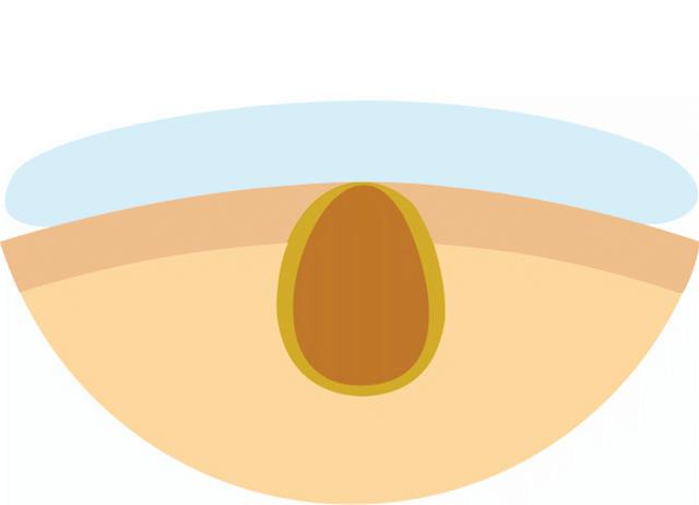 皮肤痘怎么消除,解决皮肤问题对策