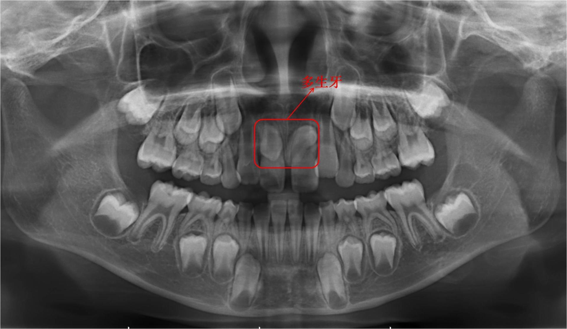 7岁小孩门牙掉了一年没长怎么办,7岁小孩门牙掉了一直不长怎么办