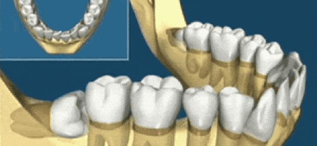 拔智齿根断在里面有什么危害,拔智齿牙根断在里面会怎么样