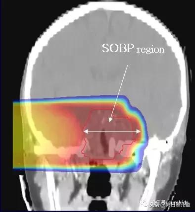 质子治肿瘤怎么样,儿童肿瘤质子治疗好吗
