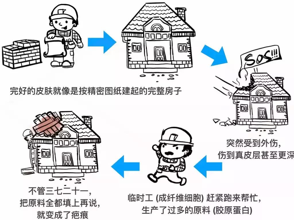 聊聊伤疤的故事,聊聊瘢痕问题