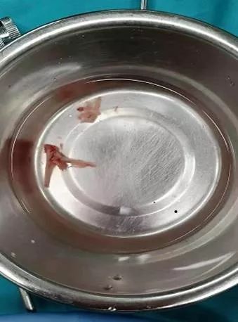 石家庄12岁男孩吃烧鸡后，咽疼、前胸疼痛！医生：这种病，可发生在任何年龄