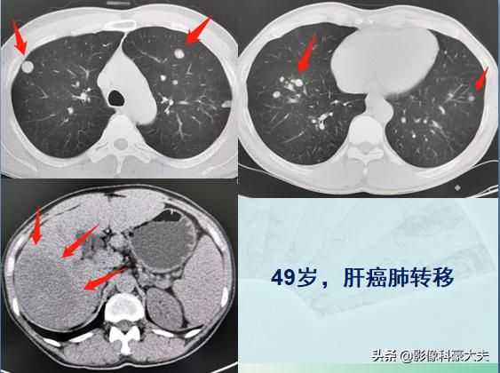 癌症晚期肺转移还能活多久,肺癌症晚期能有必要化疗吗