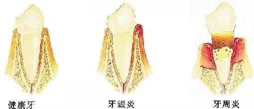 牙龈肿痛出血真的是上火吗,牙齿上火牙龈红肿怎么治疗