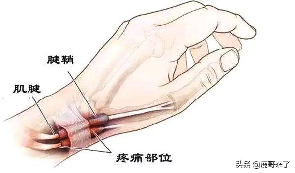 产后手腕疼痛解决方法,产后妈妈手腕疼是什么原因呢