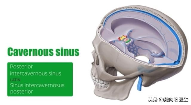 颈动脉海绵窦瘘症状,颈动脉海绵窦瘘介入需要多少钱