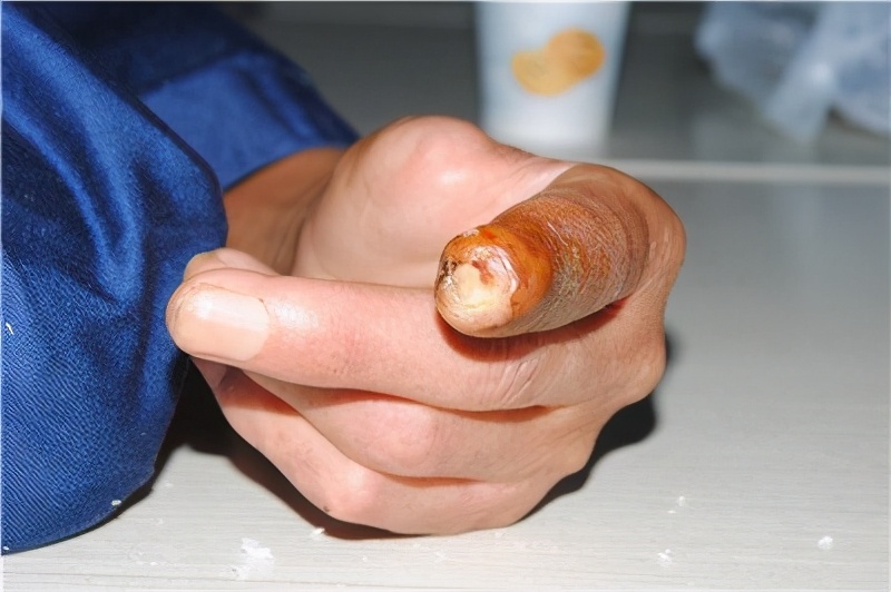 骨髓炎的原因及治疗办法,骨髓炎需要怎么治