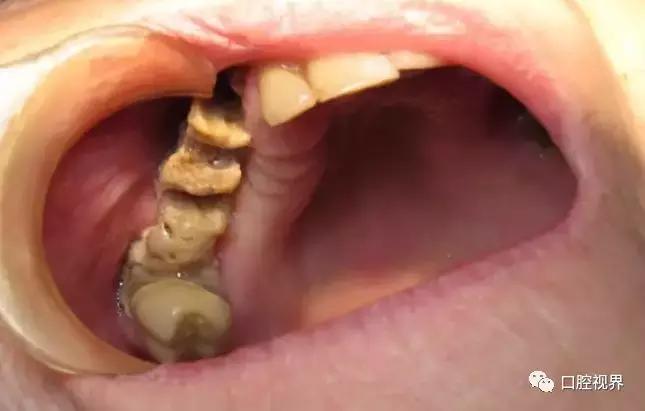 服用阿司匹林期间拔牙出血咋办,吃双膦酸盐类药物能拔牙吗