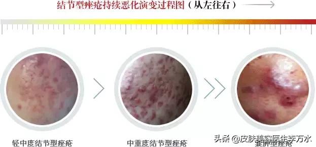 痘痘十大真相,痘痘大全图解