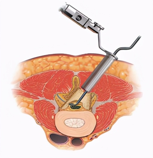 腰椎管狭窄微创手术有几种,腰椎狭窄微创手术有什么害处