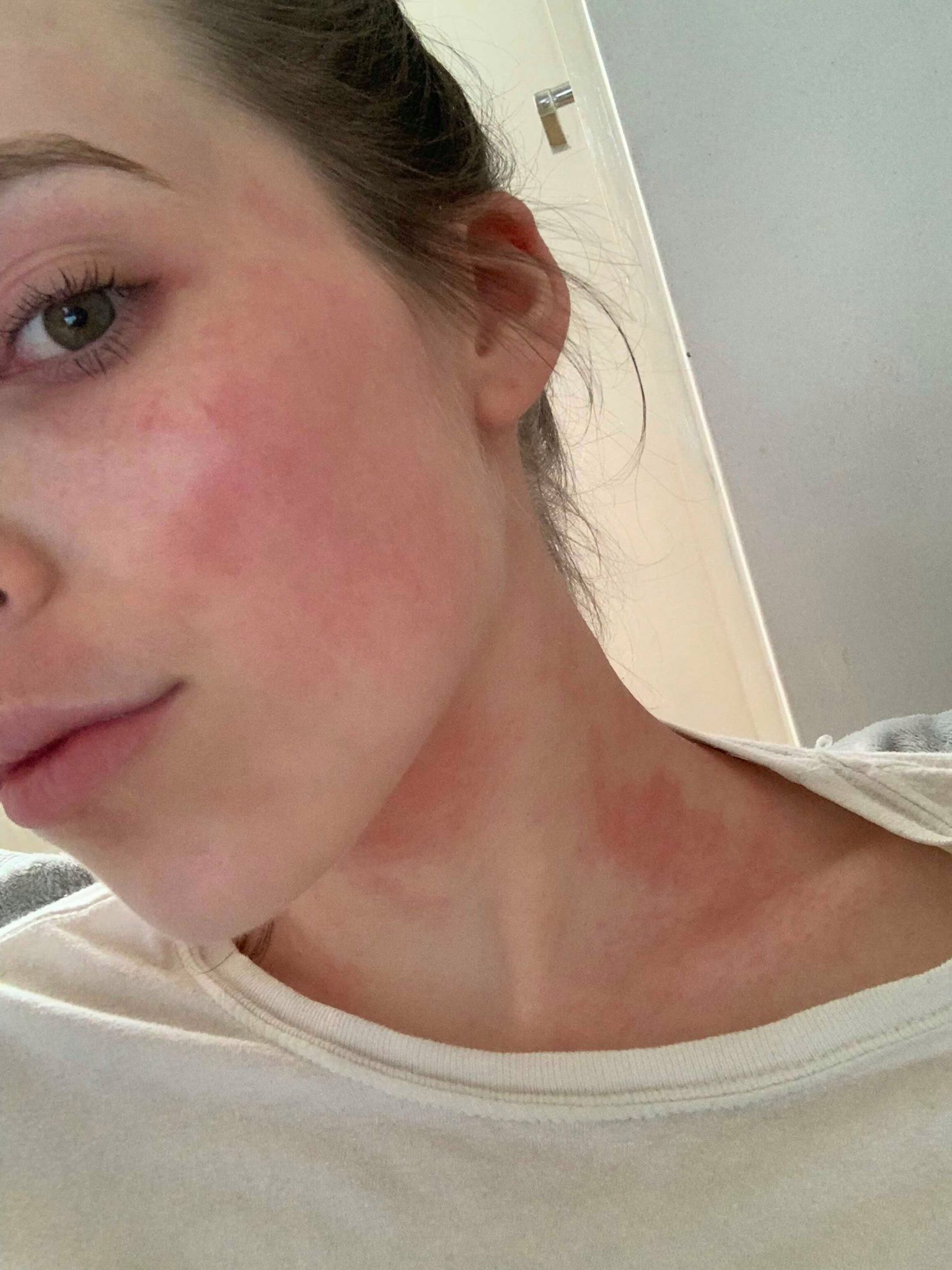 11岁女孩全身长湿疹是怎么回事,33岁女子身上长湿疹一查尽是癌