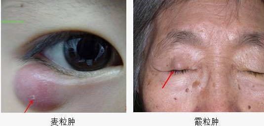 眼皮有个鼓包会自动消失吗,眼皮上长了一个包十天了还没好