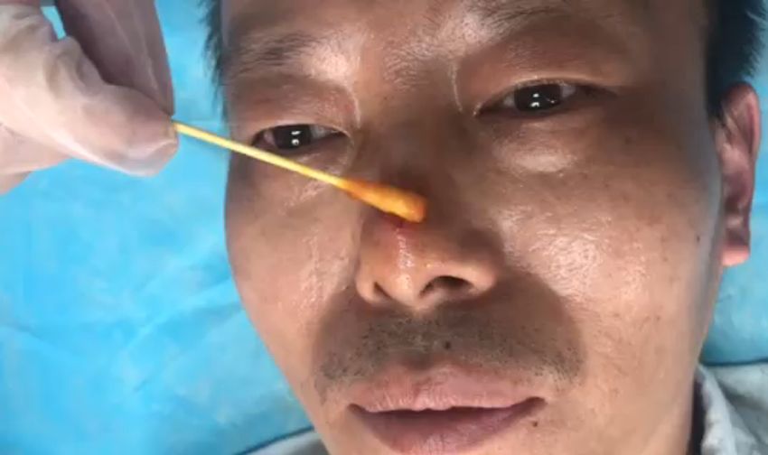 中医火针疗法教学视频,火针操作手法