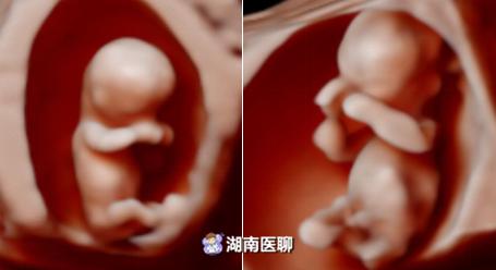 错过预约四维彩超最佳时间怎么办,四维彩超错过预约时间了怎么办