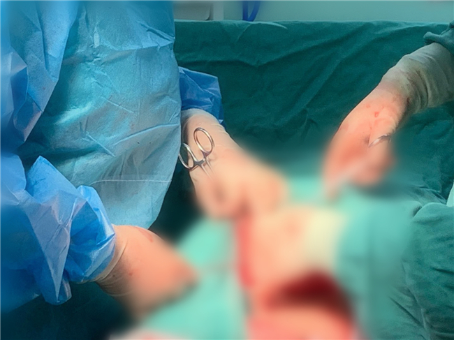 全国罕见!遂宁一22岁孕妈剖腹产遭遇膀胱异位