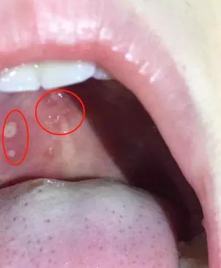 利巴韦林对手足口效果怎么样,手足口病喝利巴韦林