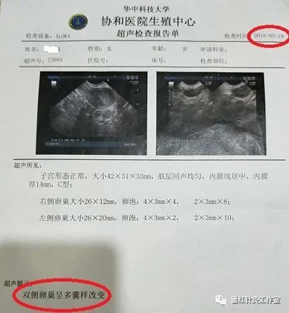 多囊卵巢综合征患者能自然怀孕吗？