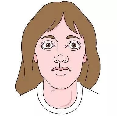 如果这6个症状全都有，不用怀疑，是甲亢来“找麻烦”了