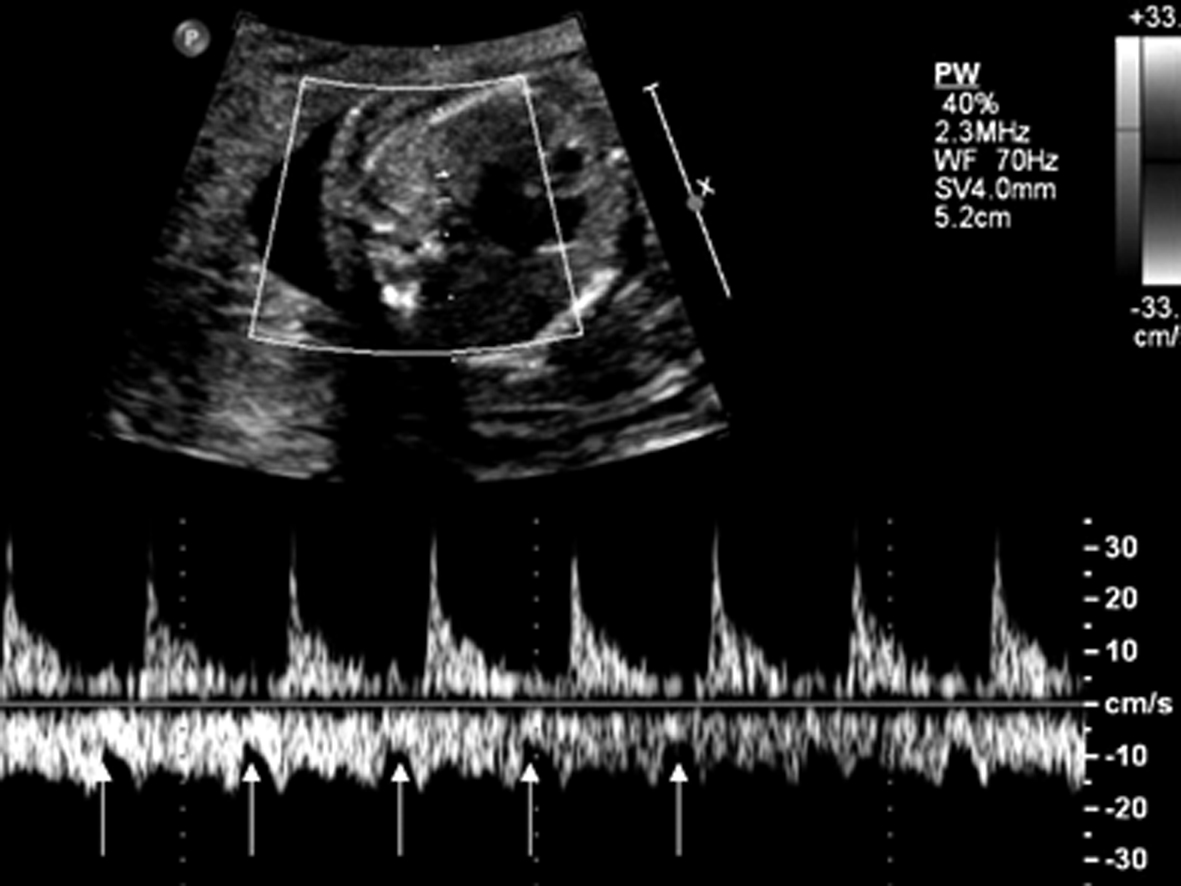 胎儿超声结果显示心跳过速,27周胎儿心律不齐早搏